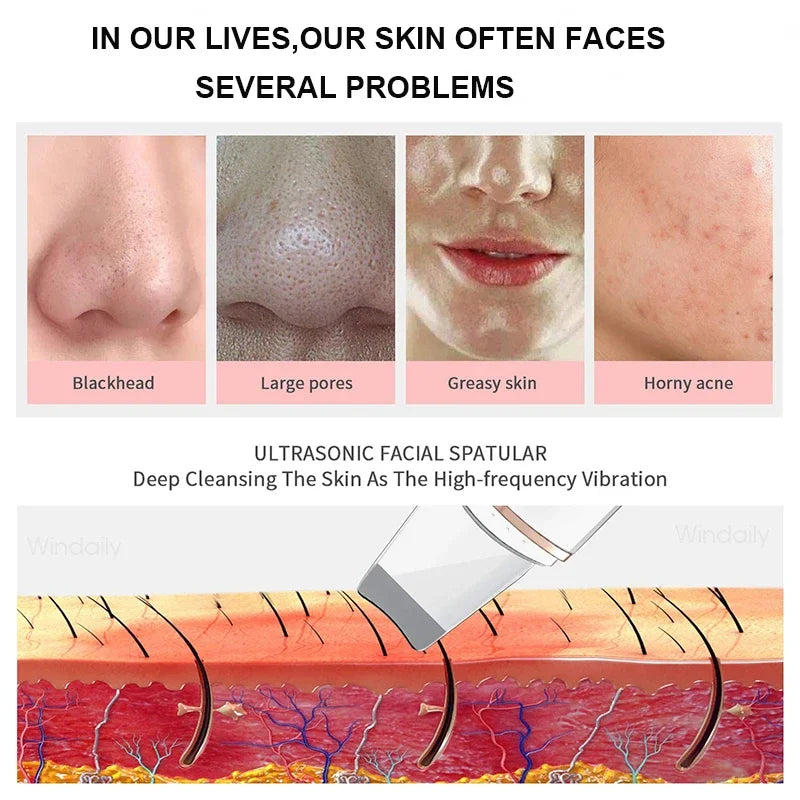 Ultrasonic Skin Care Spatula Vibration Blackhead Remover Cavitation Shovel Facial Exfoliation Skin Care Tools