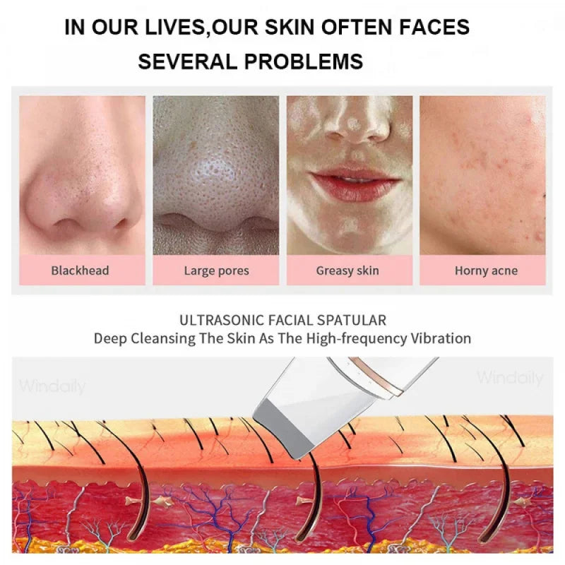 Ultrasonic Skin Care Spatula Vibration Blackhead Remover Cavitation Shovel Facial Exfoliation Skin Care Tools