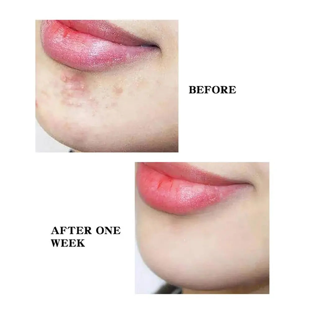 Star Pimple Patch Acne Colorful Invisible Acne Removal Skin Care Stickers Concealer Face Spot Beauty Makeup Tools 300/600pcs